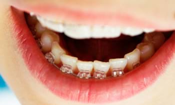 Ortodonti Tedavisinin Faydaları Nelerdir?